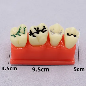 Dantų Modelio Dantis Dantų Mokymo Modelių Tyrimas Nuimamas Ortodontinis Dantų Implantas Modeliai Stomatologas Medžiaga